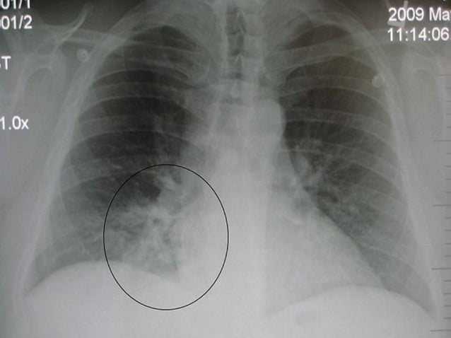 Paeds chest x ray | PPT