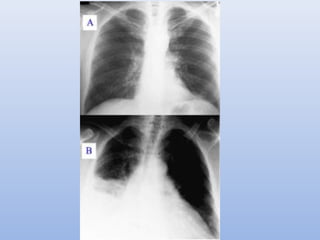 Paeds chest x ray | PPT