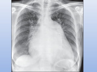 Paeds chest x ray | PPT