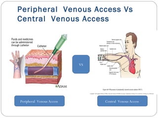 Peripheral Venous Access Vs
Central Venous Access
VS
Peripheral Venous Access Central Venous Access
 
