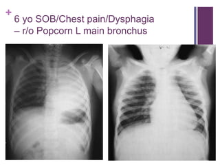 +
6 yo SOB/Chest pain/Dysphagia
– r/o Popcorn L main bronchus
 