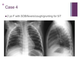 +
Case 4
 2 yo F with SOB/fevers/cough/grunting for 5/7
 Pneumonia
 