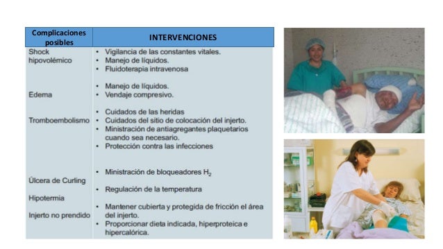 cuidados de enfermería en pacientes quemados