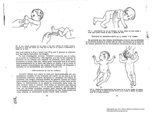 FIO. 4. .Movlmlentoa de 010 de muftoCa.: on eaté reflalo      101 010.0   tl<lndon •
                                                                                                    mlr., hacll arrlbl cuando u blll II c.boza dal nllo.

                                                                                                         RIll'LtlJos 011 BNDIlR'I!'ZAM1I!NTO DS LA. CA!.lBZA '{ BL CUBI'lPO

                                                                                                     E.s probable que dos l'elejol relacionados entre st, quo se advierten
                                                                                                  en el inrante durante el primer al"lo de vida. contriblyan a la ejecución
                                                                                                  en tiempo posterior de los movimientos voluntarios de dars" vuelta en
    Fin. 3. los ren_los prensllu de 111 manos y 101 pies tambl~n so pueden provoenr
    movlon¡Jo 01 brdlO de' Inlanhl de n'OdO que   ti   alele d_ su euarpo   ° coloe'ndule   UI
    oblato on la mano.

    slÓn muy Inferior a 40 g o mayor que 120 g, por lo general se sospecha
    que hay alguna disfunción neurológic:a.
        P.." UIIII In"c:stlgllclón rcdcnlc, Twhchcll cmnpl'ohó ,que el !'elle.lo
    de pn:mlón ell lIultlfucétlco. Ullo significa que hny vIII'lns manel'ns de
    provocar en un ¡nfllnte una reacción de prenslón, c:ntre ellas, 111 tic
    extenderle el brazo. ~tás aIO, dicho autor comprobó que ~I se colocn
     momentáneamente en la mano del Infante un objeto y se 10 retira, el
     bebé buscará manualmente ese objeto: esta reacción de büsqucda ~
     prenslón no es acompaiada por atención visual (17),           i
                          «MOVIMIENTOS DI! OJO DI! MulleC.l.-                 .1
                                                                               ¡jI
         Áqll~IIO$ reflejos que, segl'ln se cree, son desencadenados por pl·O·
     pioceptores situados en los músculos del cuello, en los ofos y en las
     membranas otolltlcas, parecen demostrar 111 necesidad del Infante de
     mantener una Imagen retiniana estable. En general, cuando se Inclina
     hacia adelante la cabeza del bebé, los ojos tienden a mirar hacia arriba
     (figura 4) .. Simllarmente, si la cabeza es mantenida hacia atrás, los
     ojos mirarán hacia el mentón. E.ste reflejo se advierte casi siempre
     en el Infante prematuro. y en el normal durante 111 primer dla de                                                (-)                                            (b)
     vida, En los bebés normales, empero, poco despllé$ del nacimiento
                                                                                                       FIO. 5. AIUalol de onUOloflml.nlo dll ClIorpo. en el. 1I Uf lotld.. ,.. cedl'..
     es reemplazado por movlml~ntos voluntarios del ojo. Como sucede con                               l. Clball olr. In la mllma direccIón. En bl. II ur ,otad, II clbe... 1.. Cid.,..
     otros renejos, su persistencia puede revelar <laio cerebral.                                     giran an la ml.ml dlreoclÓn.

                                              78                                                                                              79
.....•
O
-.J

                                                                                                                                Digitalizado por: I.S.C. Hèctor Alberto Turrubiartes Cerino
                                                                                                                                hturrubiartes@beceneslp.edu.mx
 