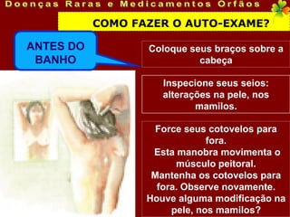 COMO FAZER O AUTO-EXAME?

ANTES DO          Coloque seus braços sobre a
 BANHO                      cabeça

                     Inspecione seus seios:
                     alterações na pele, nos
                            mamilos.

                   Force seus cotovelos para
                               fora.
                   Esta manobra movimenta o
                        músculo peitoral.
                   Mantenha os cotovelos para
                    fora. Observe novamente.
                  Houve alguma modificação na
                       pele, nos mamilos?
 