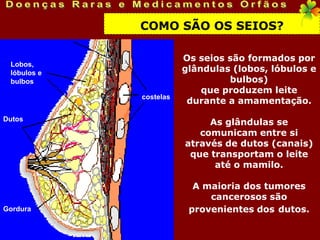 COMO SÃO OS SEIOS?

                        Os seios são formados por
 Lobos,
 lóbulos e              glândulas (lobos, lóbulos e
 bulbos                          bulbos)
                            que produzem leite
             costelas
                         durante a amamentação.
Dutos
                             As glândulas se
                           comunicam entre si
                        através de dutos (canais)
                         que transportam o leite
                              até o mamilo.

                          A maioria dos tumores
                             cancerosos são
Gordura                  provenientes dos dutos.
 