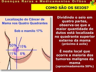 COMO SÃO OS SEIOS?

                               Dividindo o seio em
 Localização do Câncer de
                                  quatro partes,
Mama nos Quatro Quadrantes
                                observa-se que a
                              maior quantidade de
       Sob o mamilo 17%
                              dutos está localizada
                             no quadrante superior
                                externo da mama
                                 (próximo à axila)

                                É neste local que
                              ocorre a maioria dos
                              tumores malignos da
                                     mama
                              (aproximadamente 50%)
 