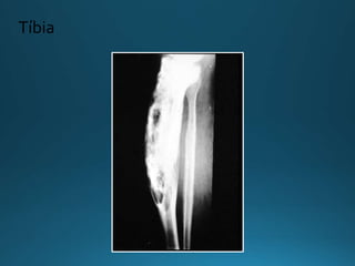 Tíbia
 