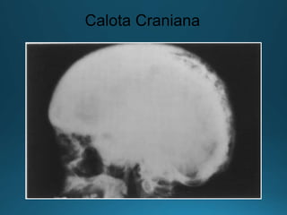 Calota Craniana
 
