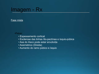 •Pelve:
• Espessamento cortical
• Esclerose das linhas ílio-pectínea e ísquio-púbica
• Asa do ilíaco pode estar envolvida
• Assimétrico (Direita)
• Aumento do ramo púbico e ísquio
Imagem - Rx
Fase mista
 