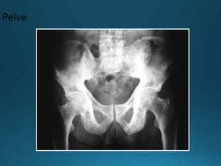 Pelve
 