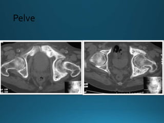 Pelve
 