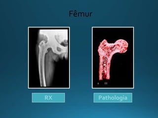 Fêmur
RX Pathologia
 