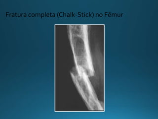Fratura completa (Chalk-Stick) no Fêmur
 