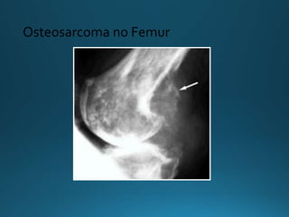 Osteosarcoma no Femur
 