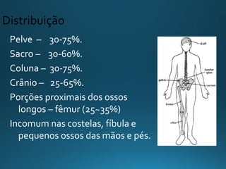 Distribuição
Pelve – 30-75%.
Sacro – 30-60%.
Coluna – 30-75%.
Crânio – 25-65%.
Porções proximais dos ossos
longos – fêmur (25~35%)
Incomum nas costelas, fíbula e
pequenos ossos das mãos e pés.
 