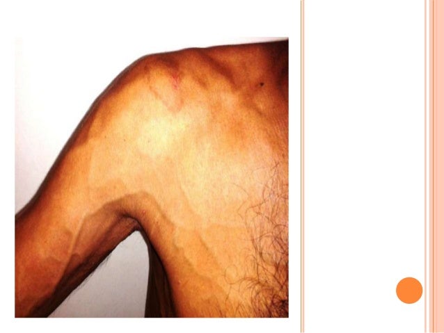 Paget schroetter syndrome presentation