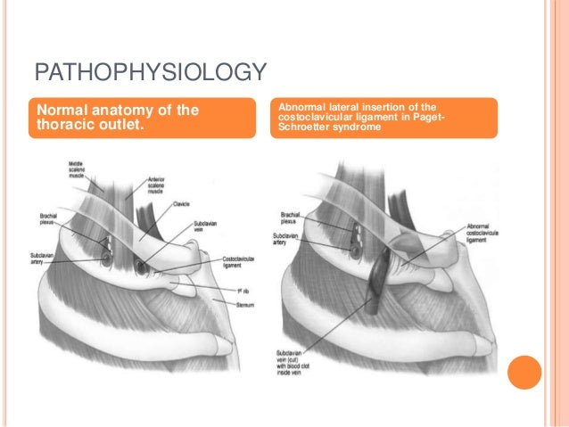 Paget schroetter syndrome presentation