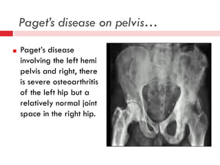 Paget’s disease on pelvis…
Paget’s disease
involving the left hemi
pelvis and right, there
is severe osteoarthritis
of the left hip but a
relatively normal joint
space in the right hip.

 