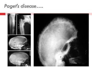 Paget’s disease….

 