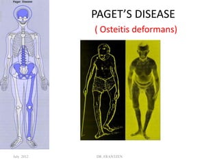PAGET’S DISEASE
( Osteitis deformans)
July 2012 DR. FRANTZEN
 