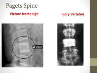 Paget Disease By Dr Diwakar Ms D ortho Orthopeadics PPTX Paget Disease By Dr Diwakar Ms D ortho Orthopeadics PPTX