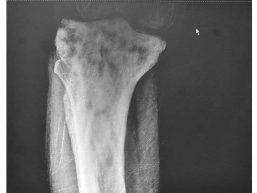 Paget's disease of bone