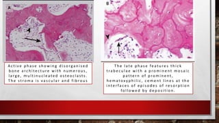 A c t i v e p h a s e s h o w i n g d i s o rga n i s e d
b o n e a rc h i t e c t u re w i t h n u m e ro u s ,
l a rg e , m u l t i n u c l e a t e d o s t e o c l a s t s .
T h e s t ro m a i s v a s c u l a r a n d f i b ro u s
T h e l a t e p h a s e fe a t u re s t h i c k
t ra b e c u l a e w i t h a p ro m i n e n t m o s a i c
p a t t e r n o f p ro m i n e n t ,
h e m a t ox y p h i l i c , c e m e n t l i n e s a t t h e
i n te r fa c e s o f e p i s o d e s o f re s o r p t i o n
fo l l o w e d b y d e p o s i t i o n .
 