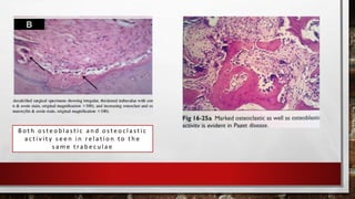 B o t h o s t e o b l a s t i c a n d o s t e o c l a s t i c
a c t i v i t y s e e n i n re l a t i o n t o t h e
s a m e t ra b e c u l a e
 