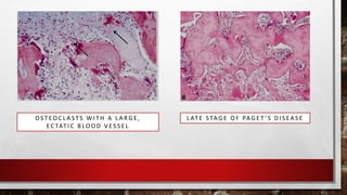 O S T EO C L A S T S W I T H A L A R G E ,
E C TAT I C B LO O D V E S S E L
L AT E S TA G E O F PA G E T ’ S D I S EA S E
 