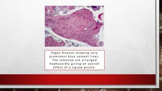 Pa g e t d i s e a s e s h o w i n g v e r y
p ro m i n e n t b l u e c e m e n t l i n e s .
T h e l a m e l l a e a re a r ra n g e d
h a p h a z a rd l y g i v i n g a n o v e ra l l
e f fe c t o f a j i g s a w p u z z l e .
 