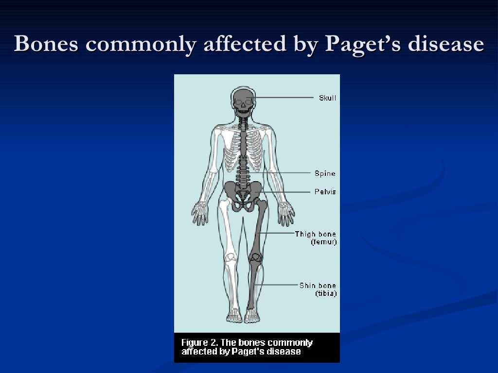 Paget’S Disease Of Bone