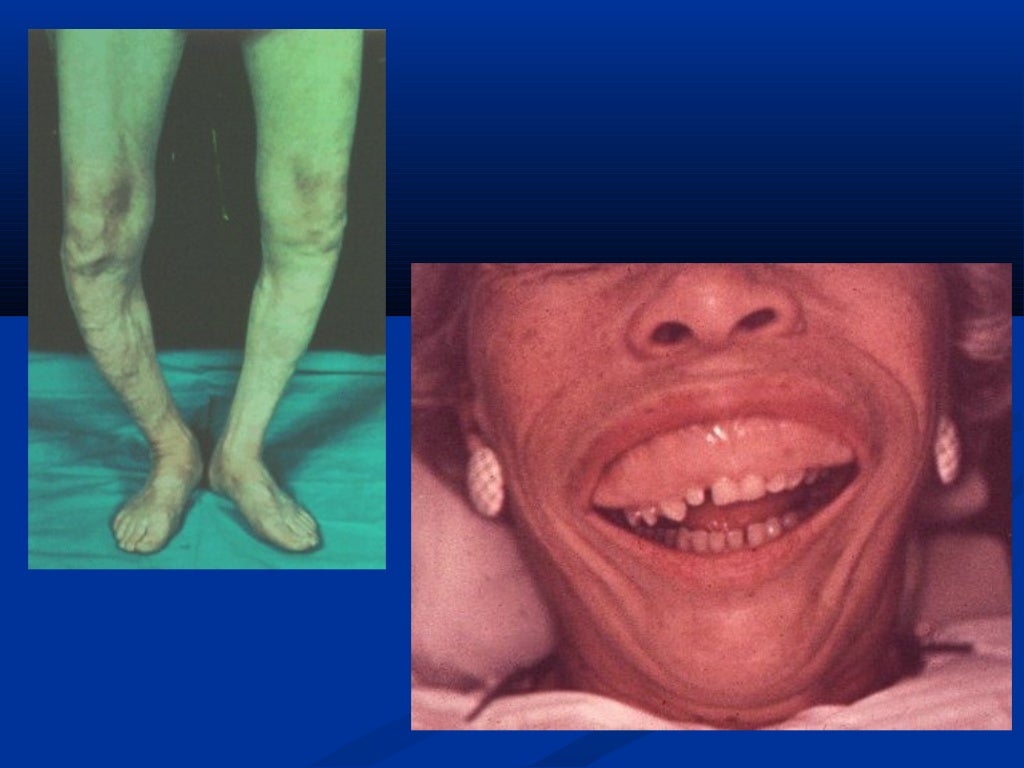 Pagets diseaseofboneby dr.athar