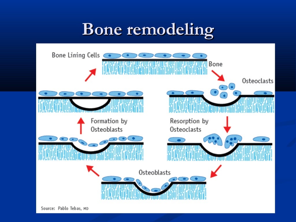 Pagets diseaseofboneby dr.athar