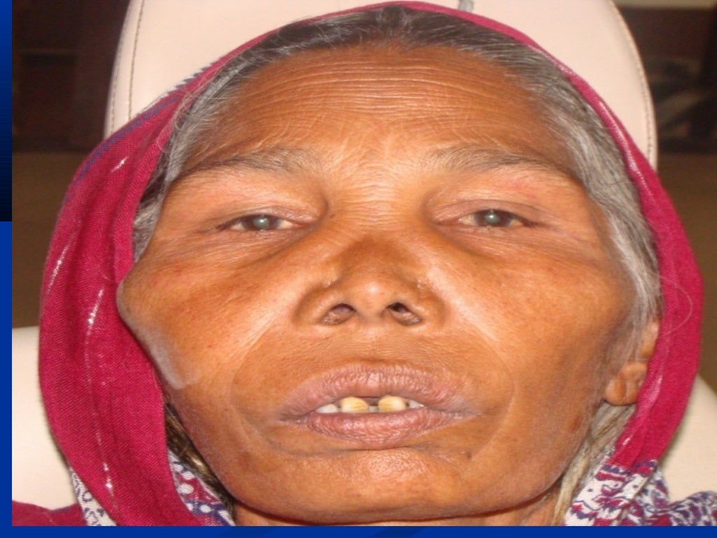 Pagets diseaseofboneby dr.athar