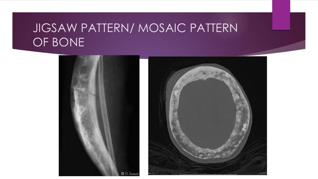 Signs in Paget’s disease