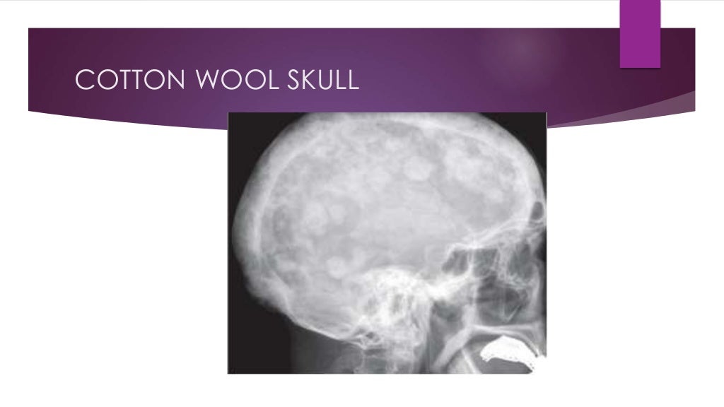 What Is The Prognosis For Paget Disease