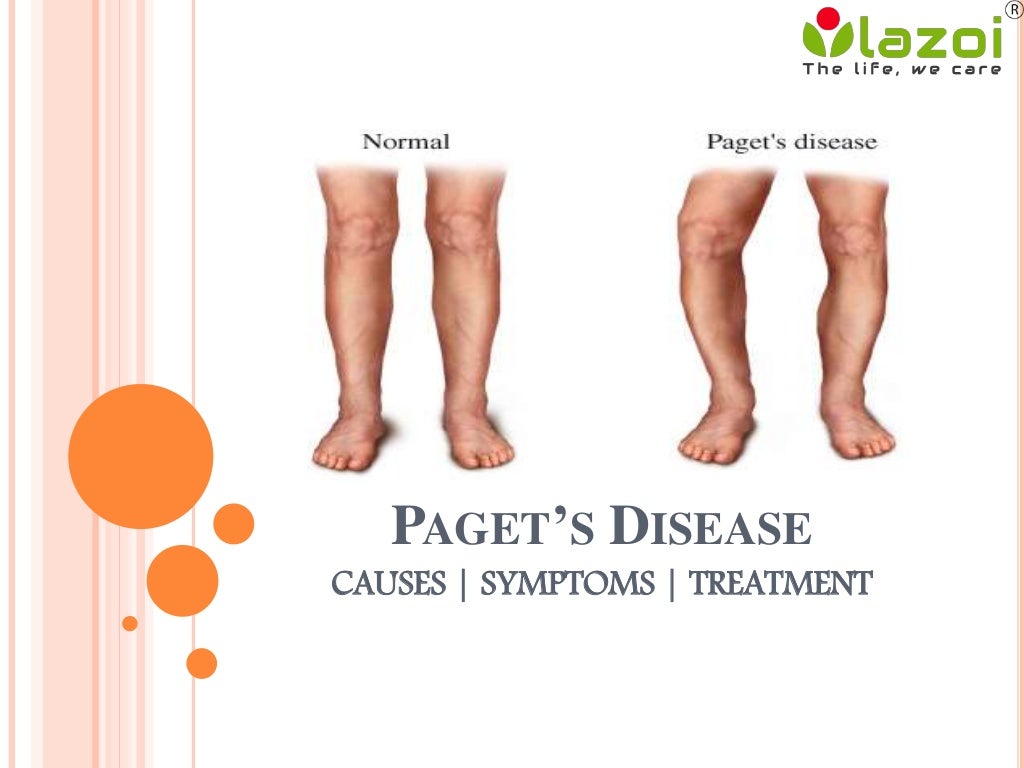 Paget’s disease causes, symptoms, diagnosis and treatment