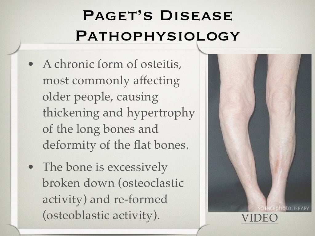 Paget's Disease Use at Darlene Gibson blog