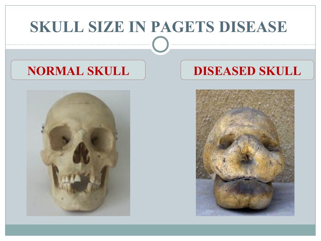 Pagets disease