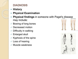 DIAGNOSIS
 History
 Physical Examination
 Physical findings in someone with Paget's disease
may include:
 Bowing of long bones
 Decreased motion
 Difficulty in walking
 Enlarged skull
 Kyphosis of the spine
 Loss of hearing
 Muscle weakness
 