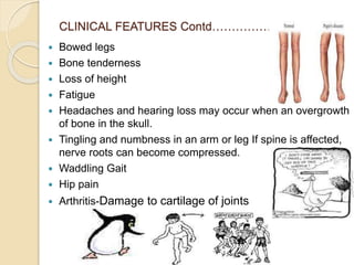CLINICAL FEATURES Contd……………
 Bowed legs
 Bone tenderness
 Loss of height
 Fatigue
 Headaches and hearing loss may occur when an overgrowth
of bone in the skull.
 Tingling and numbness in an arm or leg If spine is affected,
nerve roots can become compressed.
 Waddling Gait
 Hip pain
 Arthritis-Damage to cartilage of joints
 