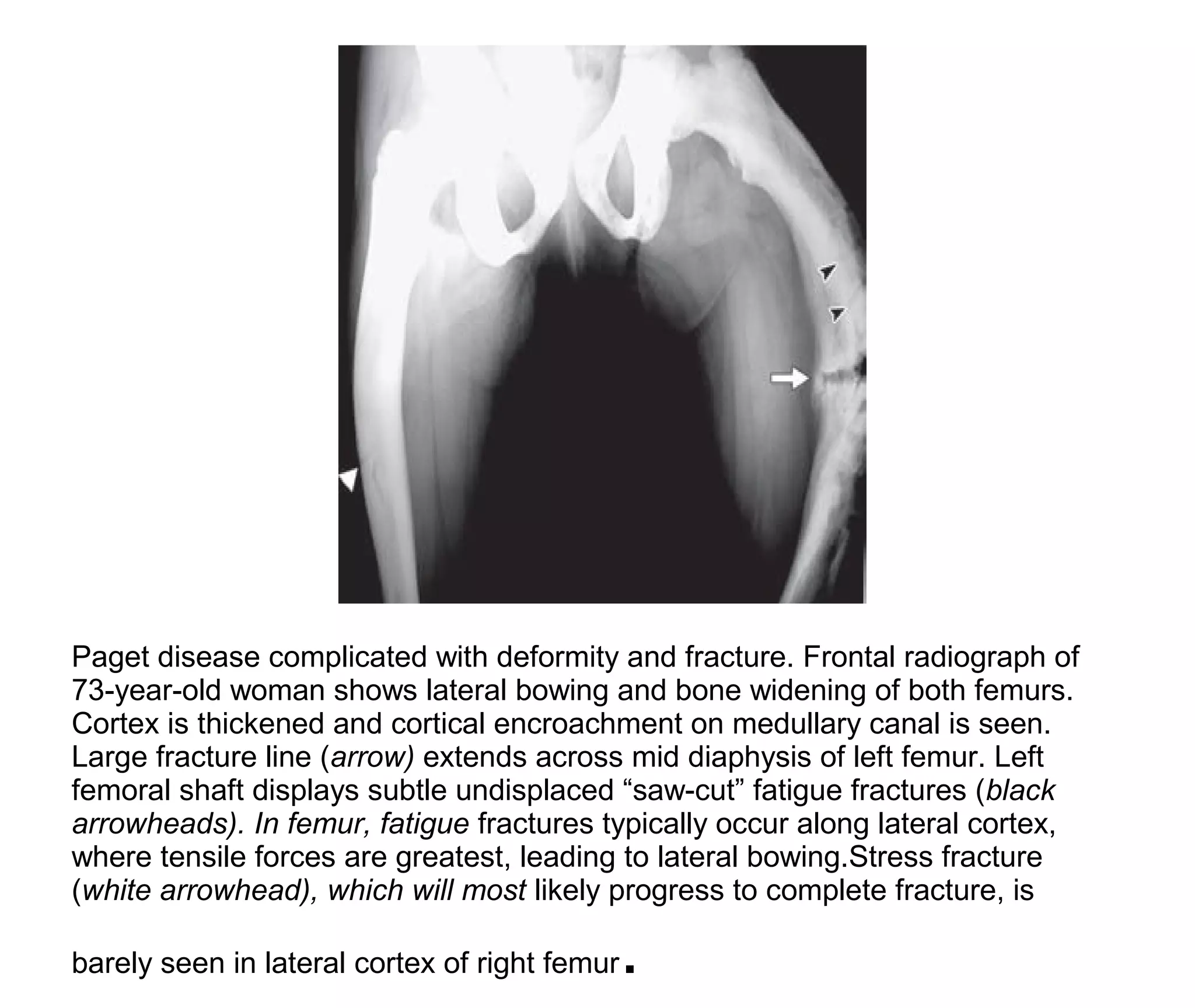 Pagets Disease Of Bone PPT pagets-disease-of-bone-ppt