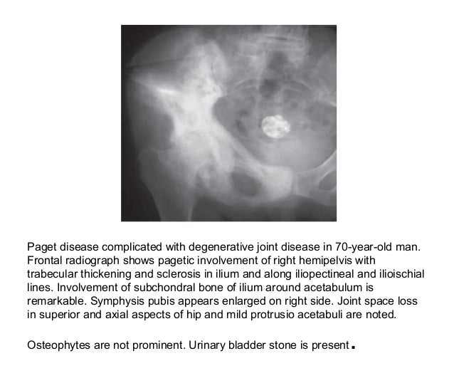 Pagets disease of bone