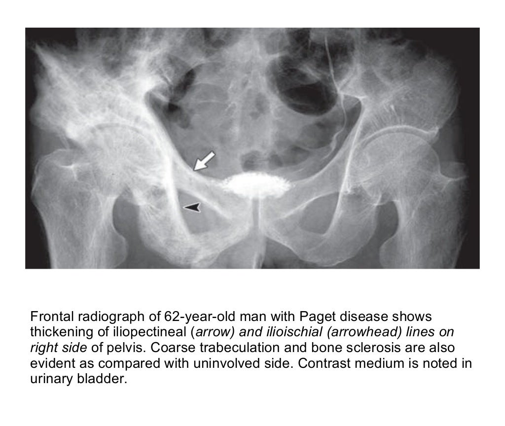 Pagets disease of bone