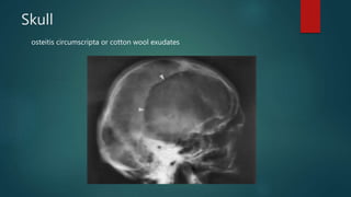 Skull
osteitis circumscripta or cotton wool exudates
 