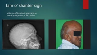 tam o' shanter sign
widening of the diploic space and an
overall enlargement of the cranium
 