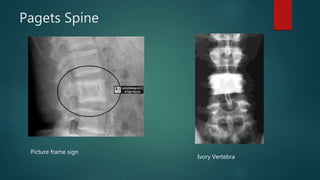 Pagets Spine
Ivory Vertebra
Picture frame sign
 