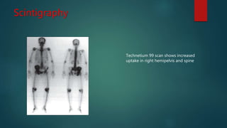Scintigraphy
Technetium 99 scan shows increased
uptake in right hemipelvis and spine
 