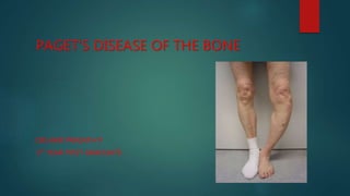 PAGET’S DISEASE OF THE BONE
DR.HARI PRASATH P
1ST YEAR POST GRADUATE
 